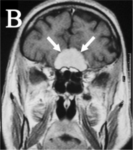Steroid induced intracranial hypertension