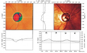 Steroid induced glaucoma pdf