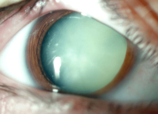 A photo showing a very dense, mature, cataract