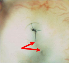 Volk Blumenthal Suturelysis Lens- broken suture seen with retracted ends