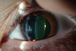 Trekken kat vork I've been told that I have mild cataract, what should I do? - Glaucoma &  Cataract, Prof. Eytan Blumenthal