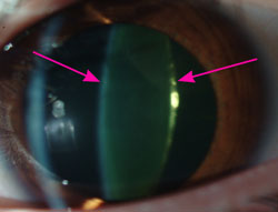 Arrows point to an early cataract seen as yellowing of the lens