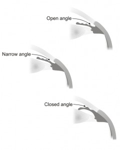 Angle-open narrow Closed