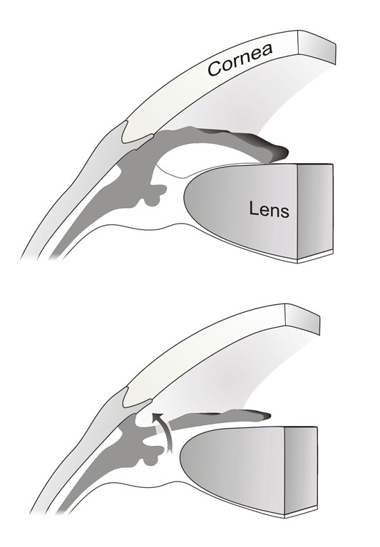 Angle closure and PI