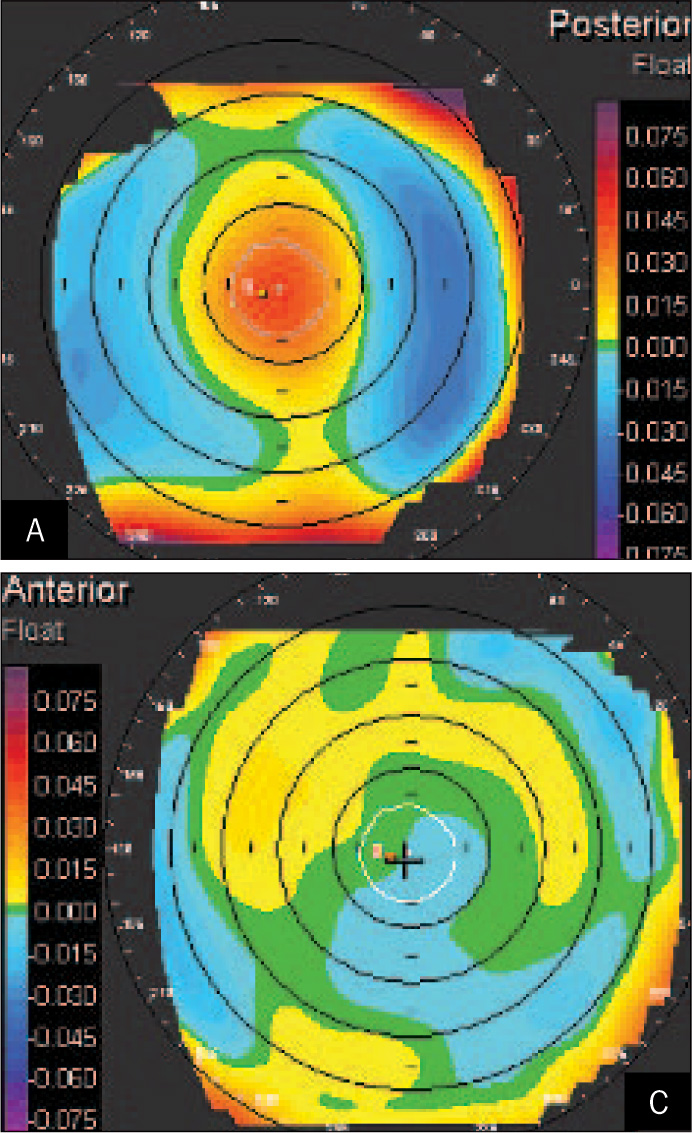 Early Transient Visual Acuity Loss After Lasik Due To SteroidInduced