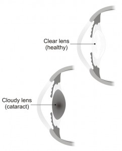 Clear lens and a cataract illustrated